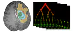 Hirni: Segmentation of Brain Tumors in Multi-parametric Magnetic Resonance Imaging Scans